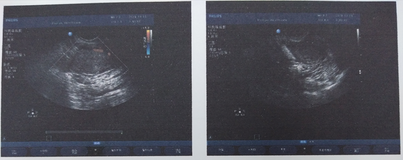 ↑圖為陰超示雙附件區(qū)增強(qiáng)回聲包塊，考慮畸胎瘤可能.png