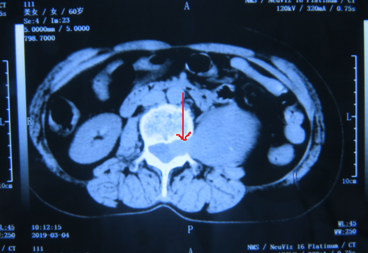 術(shù)前CT   箭頭所指腫塊經(jīng)椎間孔進(jìn)入椎管.png