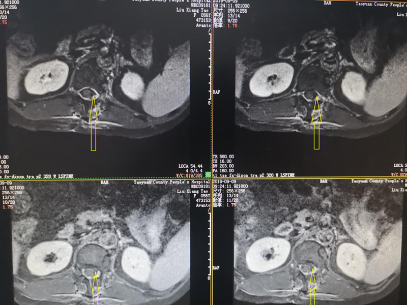 術(shù)后MRI 箭頭所指腫瘤已消失.png