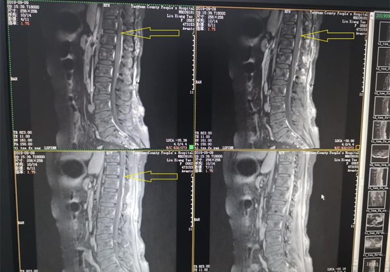 術(shù)后MRI 箭頭所指腫瘤已消失2.png